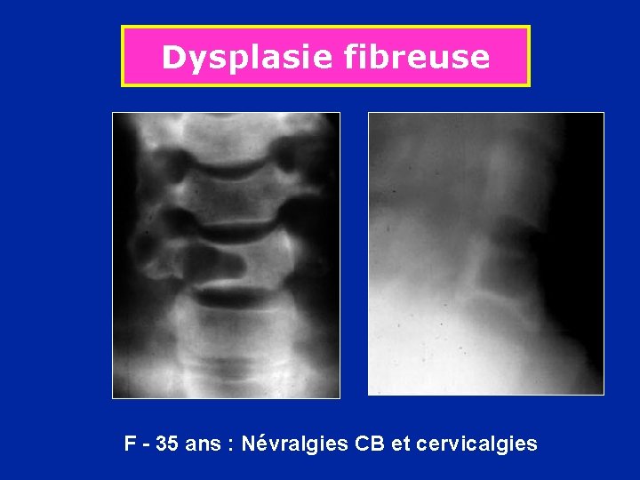 Dysplasie fibreuse F - 35 ans : Névralgies CB et cervicalgies 