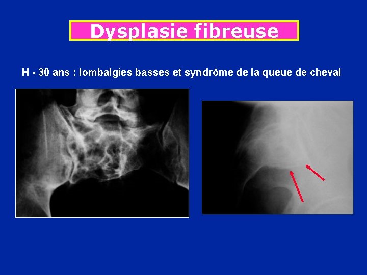 Dysplasie fibreuse H - 30 ans : lombalgies basses et syndrôme de la queue