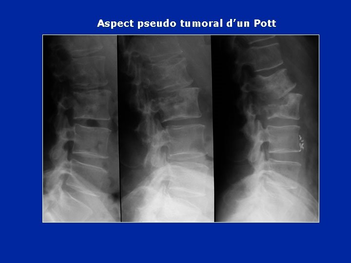 Aspect pseudo tumoral d’un Pott 