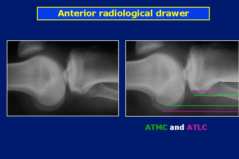 Anterior radiological drawer ATMC and ATLC 