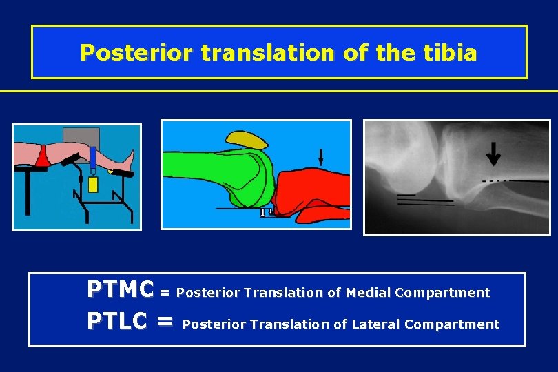 Posterior translation of the tibia PTMC = Posterior Translation of Medial Compartment PTLC =