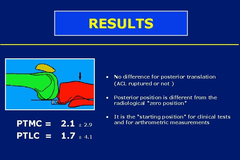 RESULTS • No difference for posterior translation (ACL ruptured or not ) PTMC =