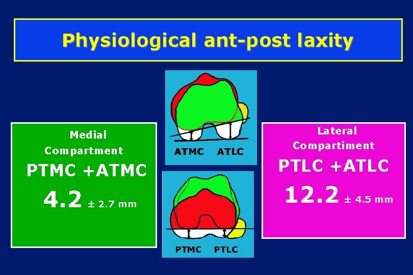 Physiological ant-post laxity Medial Compartment PTMC +ATMC 4. 2 ± 2. 7 mm Lateral