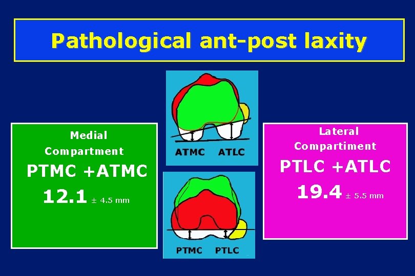 Pathological ant-post laxity Medial Compartment PTMC +ATMC 12. 1 ± 4. 5 mm Lateral
