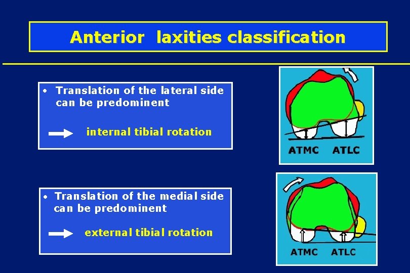 Anterior laxities classification • Translation of the lateral side can be predominent internal tibial