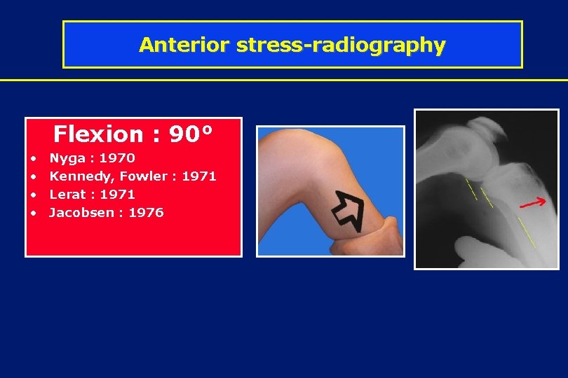 Anterior stress-radiography Flexion : 90° • • Nyga : 1970 Kennedy, Fowler : 1971