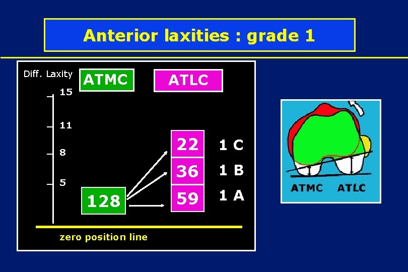 Anterior laxities : grade 1 Diff. Laxity 15 ATMC ATLC 1 D 11 8