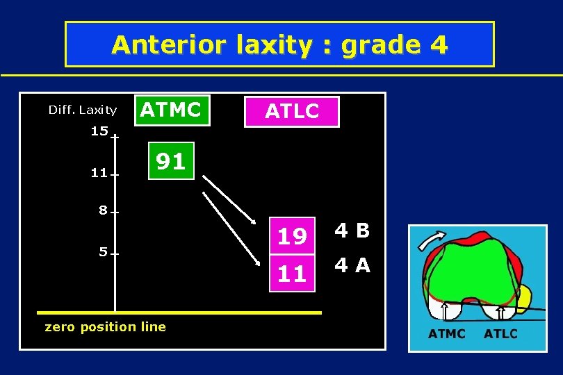 Anterior laxity : grade 4 Diff. Laxity ATMC ATLC 15 11 91 4 D