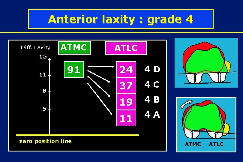 Anterior laxity : grade 4 Diff. Laxity ATMC ATLC 91 24 4 D 37