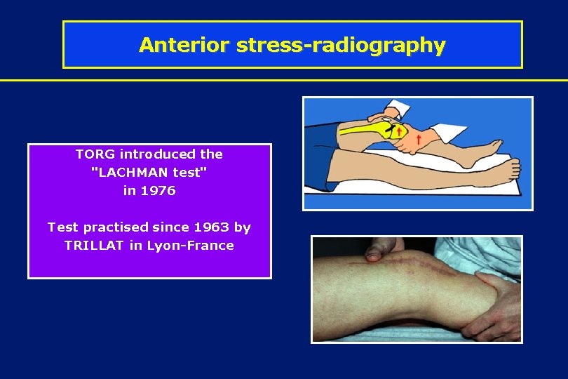Anterior stress-radiography TORG introduced the "LACHMAN test" in 1976 Test practised since 1963 by