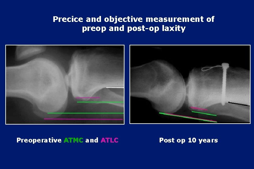 Precice and objective measurement of preop and post-op laxity Preoperative ATMC and ATLC Post