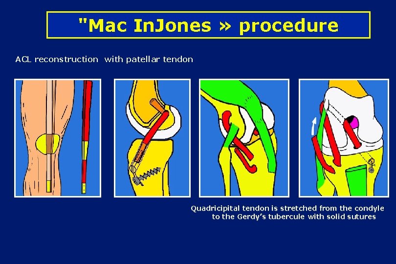"Mac In. Jones » procedure ACL reconstruction with patellar tendon Quadricipital tendon is stretched