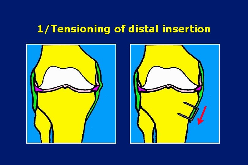 1/Tensioning of distal insertion 