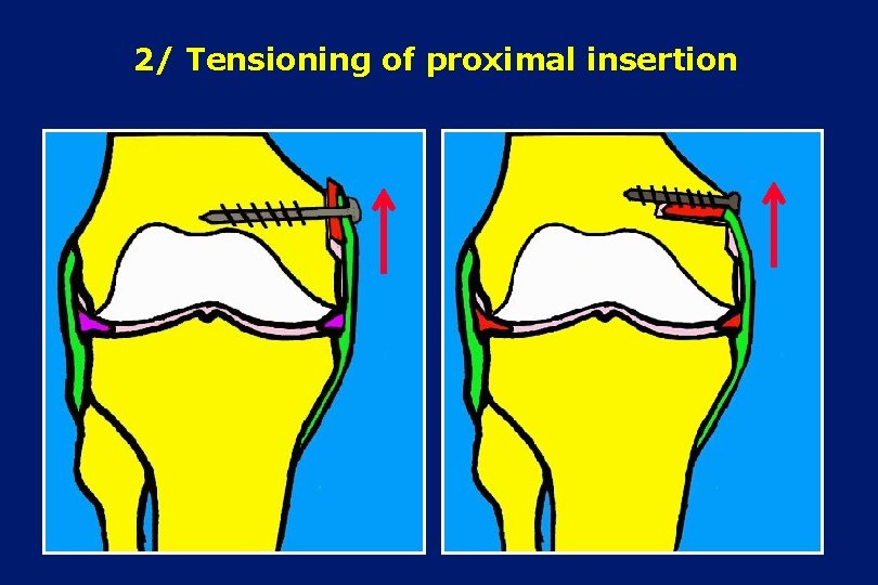 2/ Tensioning of proximal insertion 