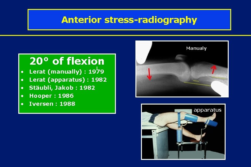 Anterior stress-radiography Manualy 20° of flexion • • • l Lerat (manually) : 1979