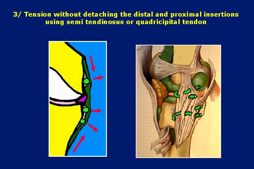 3/ Tension without detaching the distal and proximal insertions using semi tendinosus or quadricipital