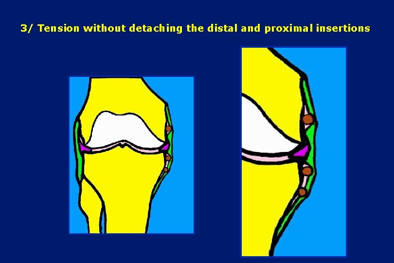 3/ Tension without detaching the distal and proximal insertions 