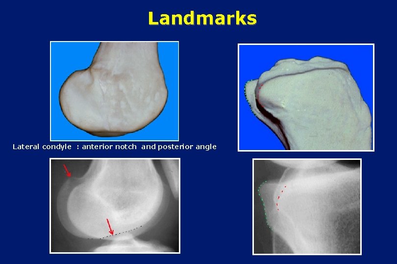 Landmarks Lateral condyle : anterior notch and posterior angle 