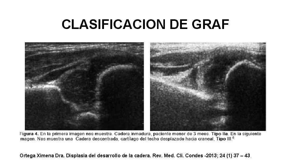 CLASIFICACION DE GRAF Ortega Ximena Dra. Displasia del desarrollo de la cadera. Rev. Med.