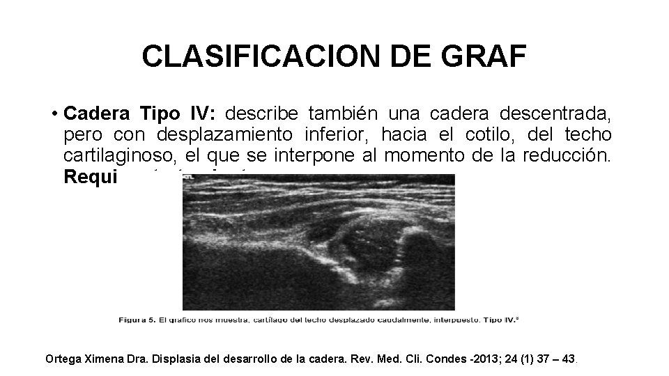 CLASIFICACION DE GRAF • Cadera Tipo IV: describe también una cadera descentrada, pero con