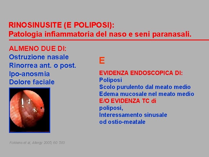 RINOSINUSITE (E POLIPOSI): Patologia infiammatoria del naso e seni paranasali. ALMENO DUE DI: Ostruzione