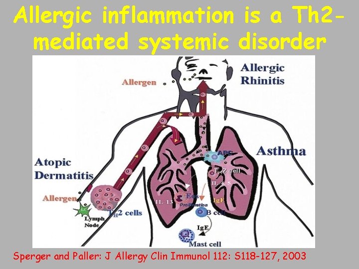 Allergic inflammation is a Th 2 mediated systemic disorder Sperger and Paller: J Allergy