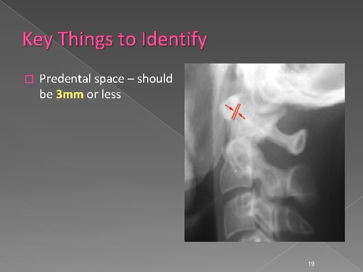 Key Things to Identify � Predental space – should be 3 mm or less