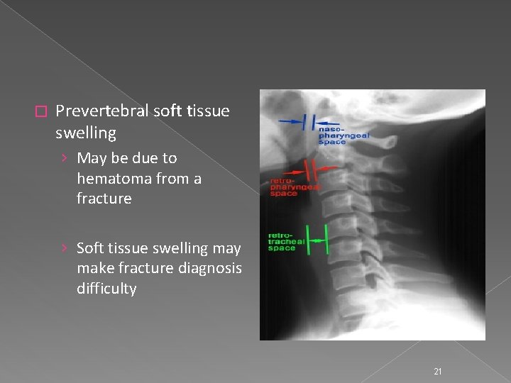 � Prevertebral soft tissue swelling › May be due to hematoma from a fracture