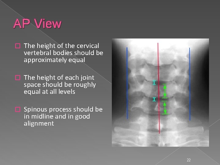 AP View � The height of the cervical vertebral bodies should be approximately equal