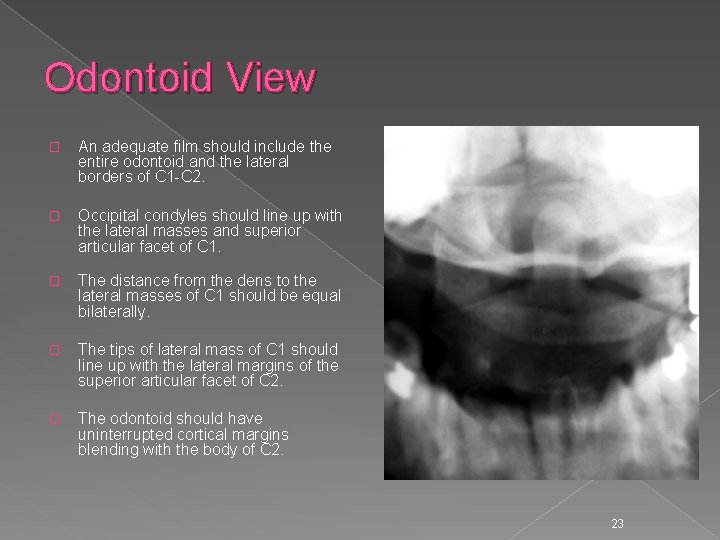 Odontoid View � An adequate film should include the entire odontoid and the lateral