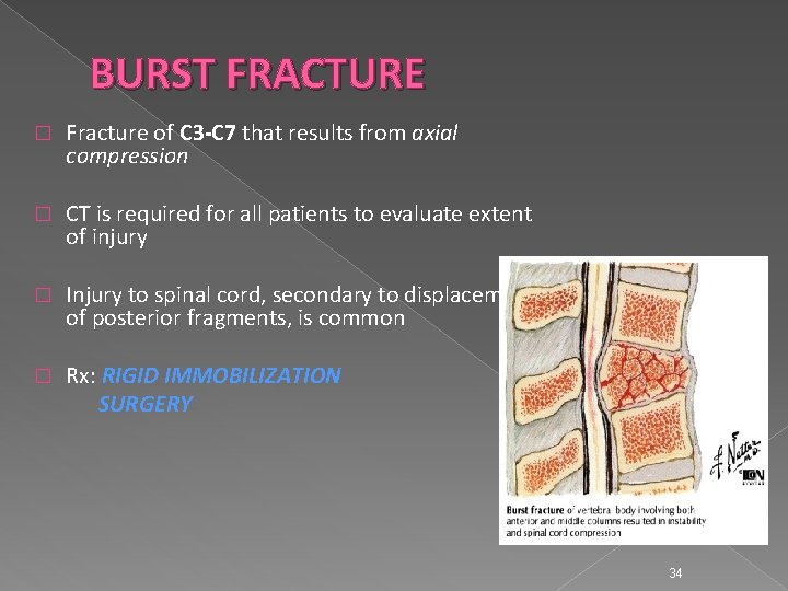 BURST FRACTURE � Fracture of C 3 -C 7 that results from axial compression