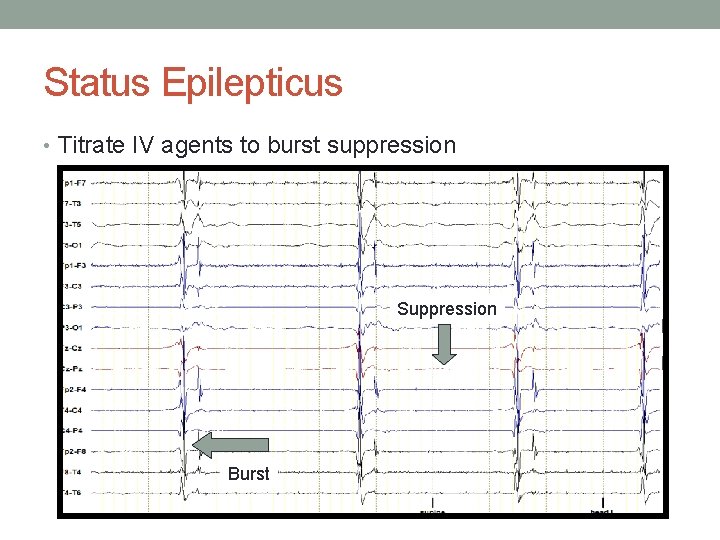 Status Epilepticus • Titrate IV agents to burst suppression Suppression Burst 