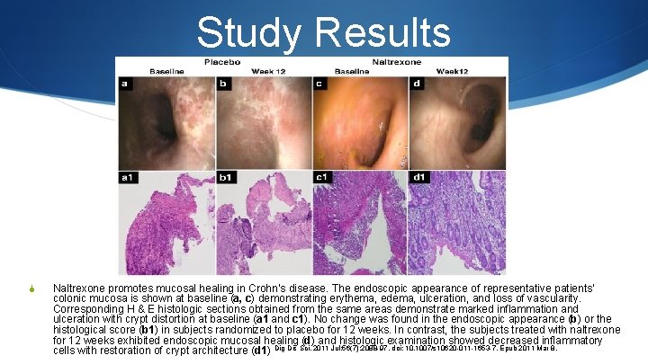 Study Results S Naltrexone promotes mucosal healing in Crohn’s disease. The endoscopic appearance of