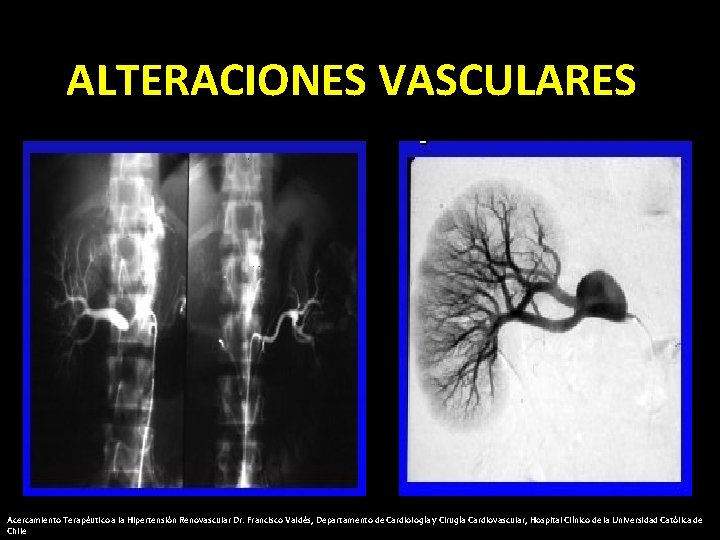 ALTERACIONES VASCULARES Acercamiento Terapéutico a la Hipertensión Renovascular Dr. Francisco Valdés, Departamento de Cardiología