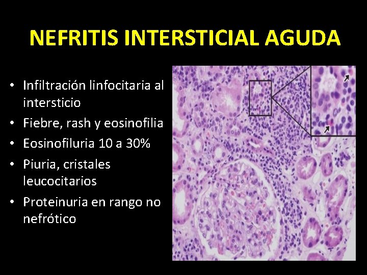 NEFRITIS INTERSTICIAL AGUDA • Infiltración linfocitaria al intersticio • Fiebre, rash y eosinofilia •