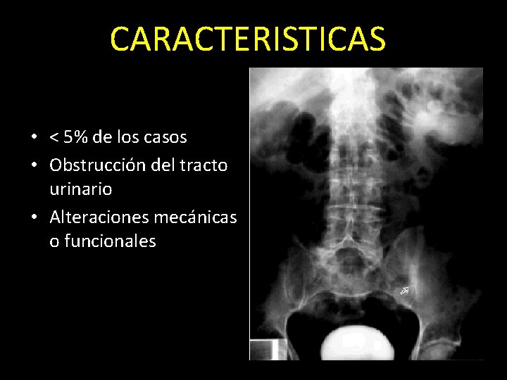 CARACTERISTICAS • < 5% de los casos • Obstrucción del tracto urinario • Alteraciones