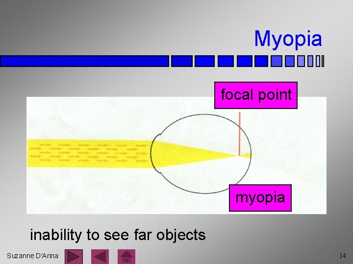 Myopia focal point myopia inability to see far objects Suzanne D'Anna 14 