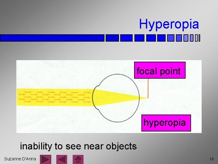 Hyperopia focal point hyperopia inability to see near objects Suzanne D'Anna 16 