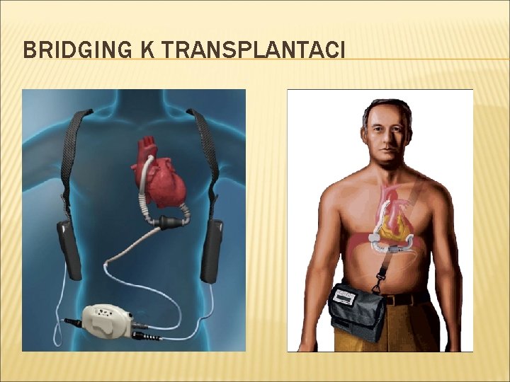 BRIDGING K TRANSPLANTACI 