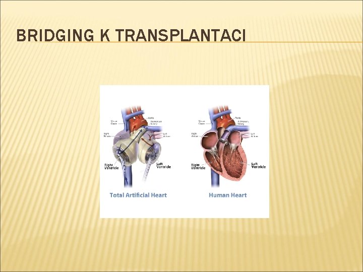 BRIDGING K TRANSPLANTACI 