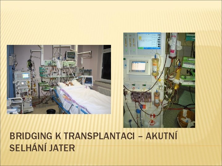 BRIDGING K TRANSPLANTACI – AKUTNÍ SELHÁNÍ JATER 