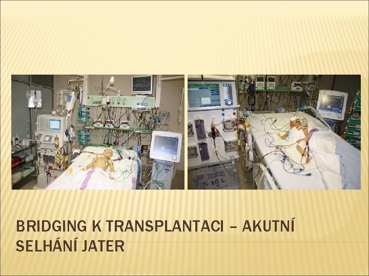 BRIDGING K TRANSPLANTACI – AKUTNÍ SELHÁNÍ JATER 