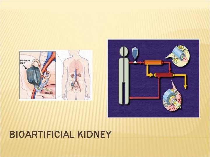 BIOARTIFICIAL KIDNEY 
