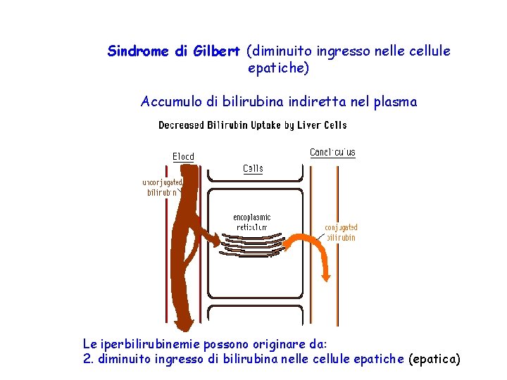  Sindrome di Gilbert (diminuito ingresso nelle cellule epatiche) Accumulo di bilirubina indiretta nel