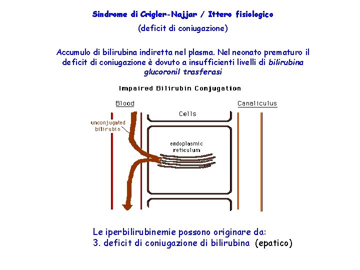 Sindrome di Crigler-Najjar / Ittero fisiologico (deficit di coniugazione) Accumulo di bilirubina indiretta nel
