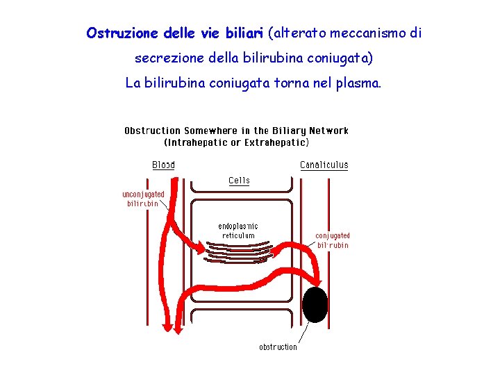 Ostruzione delle vie biliari (alterato meccanismo di secrezione della bilirubina coniugata) La bilirubina coniugata