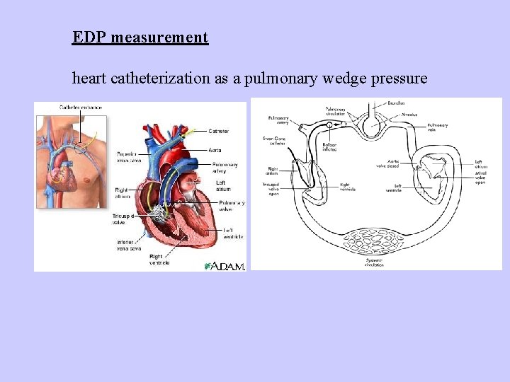EDP measurement heart catheterization as a pulmonary wedge pressure 