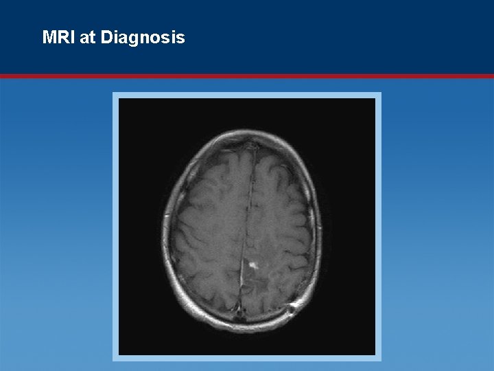 MRI at Diagnosis 