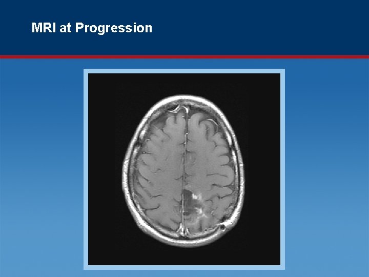 MRI at Progression 