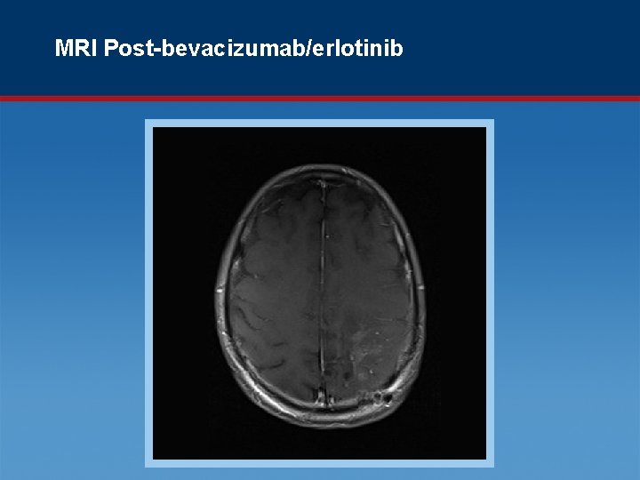 MRI Post-bevacizumab/erlotinib 
